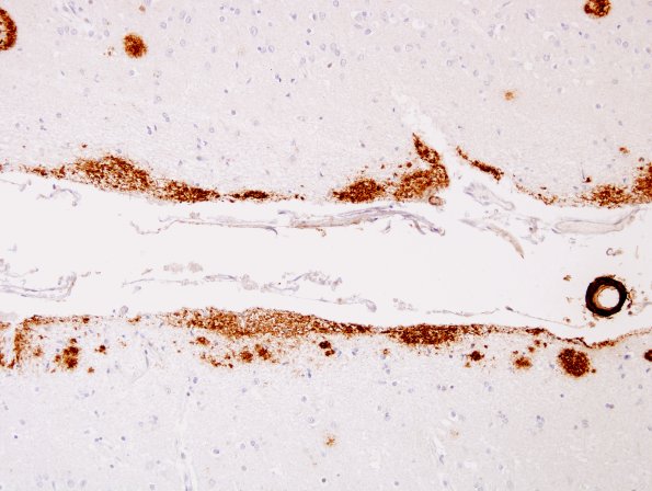 2H2 AD Subpial Amyloid BAmyloid 3.jpg