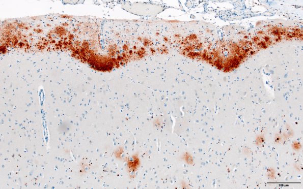 2H3 AD changes, Amyloid Bamyloid 1