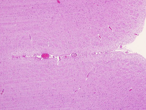 3B1 AD (Presenilin Mutation) H&E 3