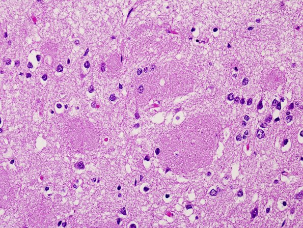 3B3 AD (Presenilin Mutation) H&E 1