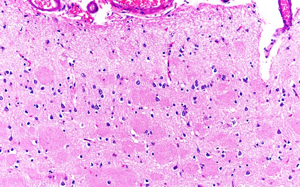 3B4 AD (Presenilin Mutation) H&E L2 20X