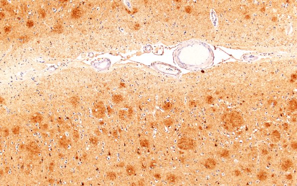 3B6B AD (Presenilin Mutation) PHF L2 10X