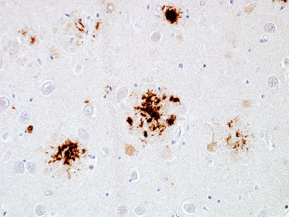 4B11 AD 5 Hippocampus area A BAmyloid 1.jpg