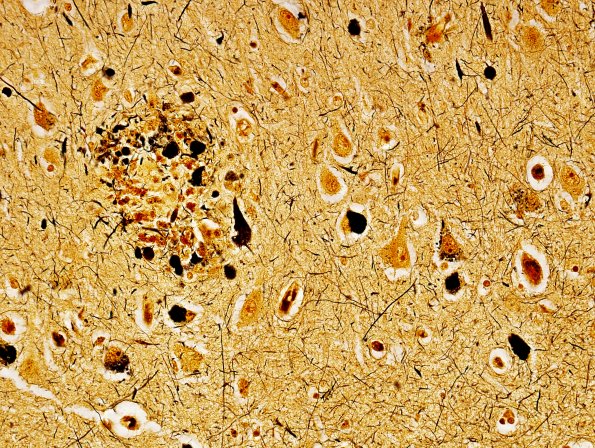 4D9 AD (Occipital atrophy) N3 Biels 1