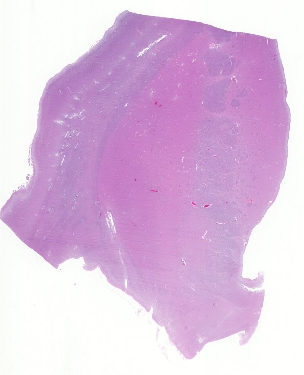 5A1 AD Caudate nucleus H&E whole mount