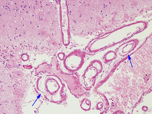 6A4 AD (CAA) capillaries H&E 3 copy