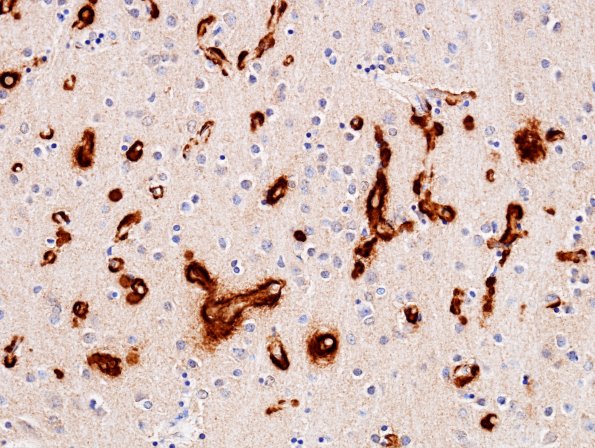 6B4 AD (CAA) capillaries BAmyloid 4