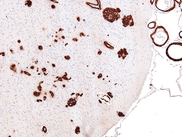 6B5 AD (CAA) capillaries BAmyloid 6