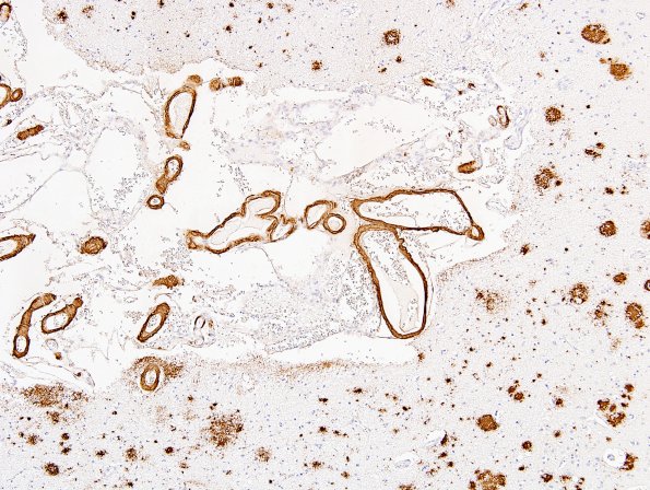 6B7 AD L1 BAmyloid 1.jpg