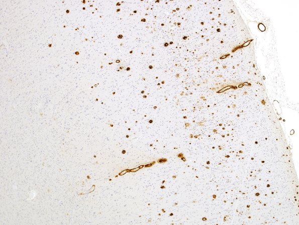 6B8 AD (CAA) GM vs WM compare w B BAmyloid