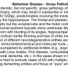 0A Alzheimer Disease - Gross Pathology - Text