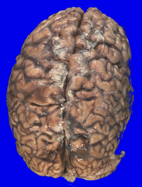 4A1 AD (Occipital atrophy, Case 4) Gross _2