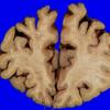 4A3 AD (Occipital atrophy, Case 4) Gross _4