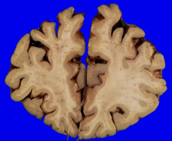 4A3 AD (Occipital atrophy, Case 4) Gross _4