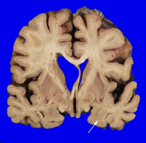 4A4 AD (Occipital atrophy, Case 4) Gross _6 copy