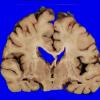 4A5 AD (Occipital atrophy, Case 4) Gross _8