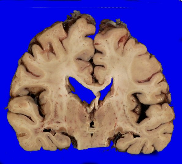 4A5 AD (Occipital atrophy, Case 4) Gross _8