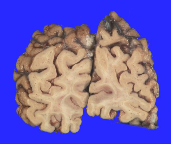 4A6 AD (Occipital atrophy, Case 4) Gross _13