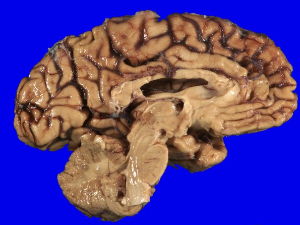 5A2 AD (grossly looks like FTD, Case 5)_8