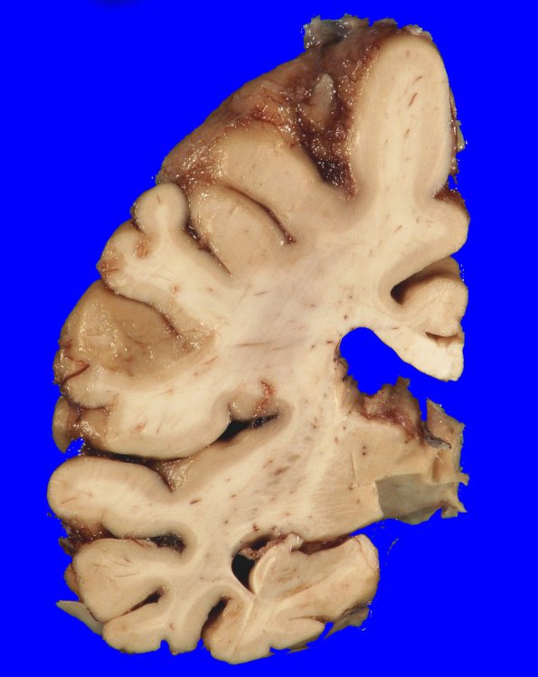 5A5 AD (grossly looks like FTD, Case 5)_14