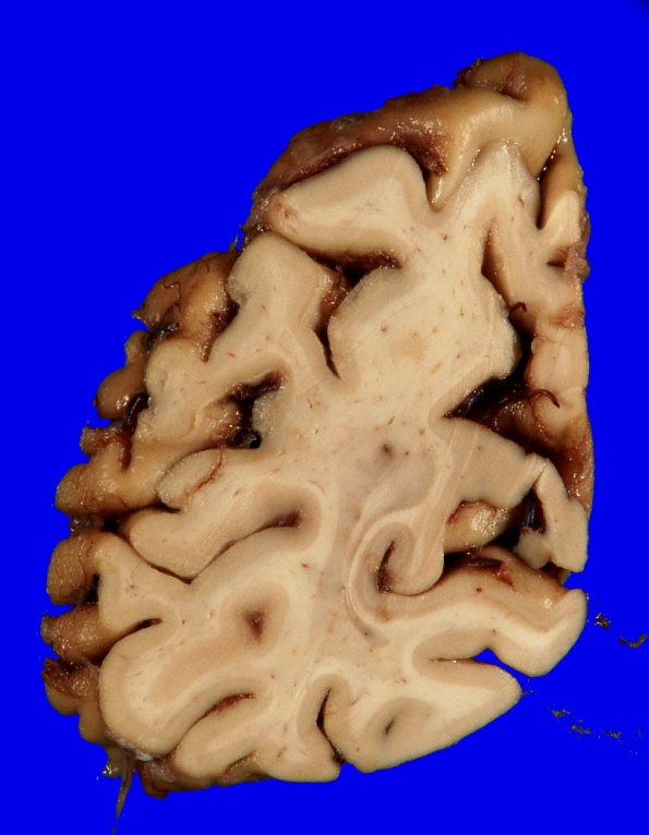 5A6  AD (grossly looks like FTD, Case 5)_17