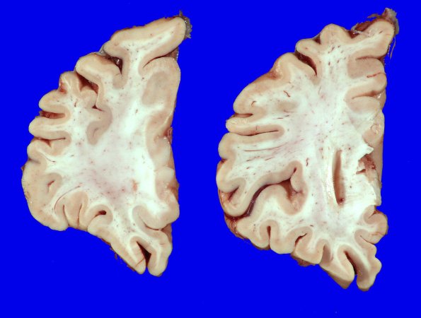 6A2 AD (Case 6) _3