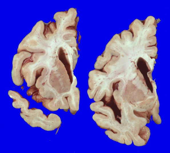 6A3 AD (Case 6) _4