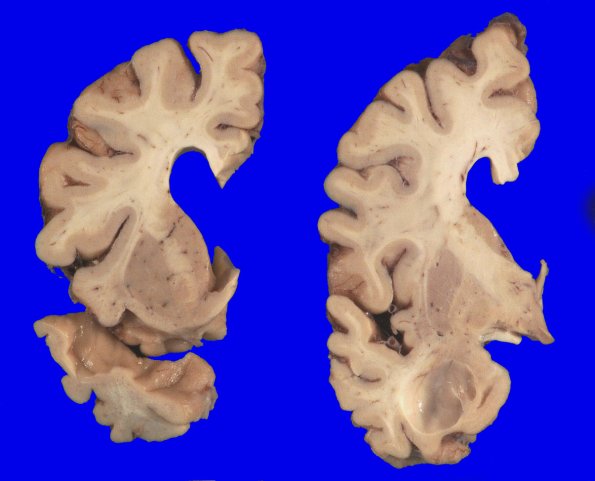 7A2 AD (Case 7) _7