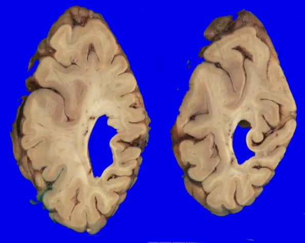 8A5 AD (Case 8) _3