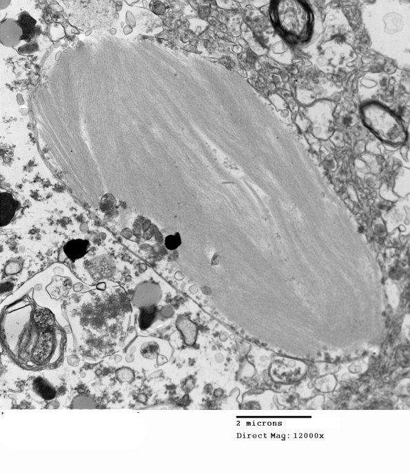 1C10 AD (Case 1) Hirano EM 061 - Copy