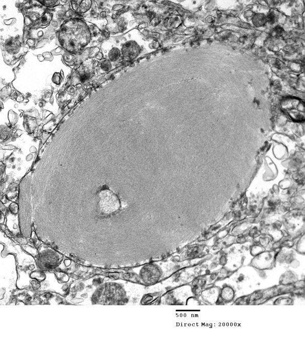 1C12 AD (Case 1) Hirano EM 065 - Copy