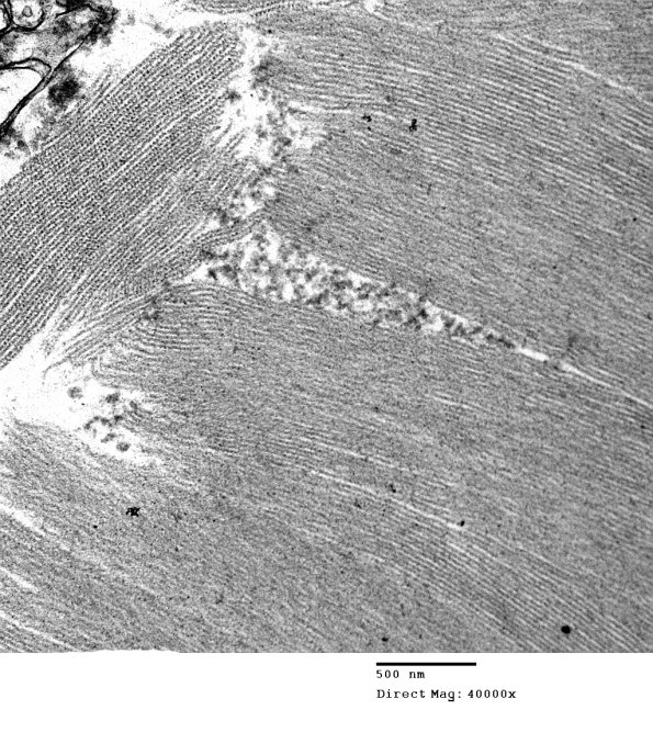 1C15 AD (Case 1) Hirano EM 015 - Copy