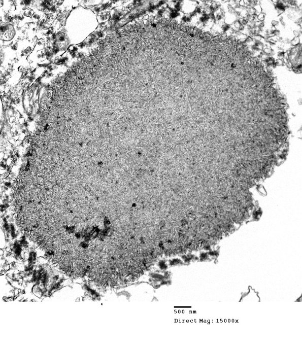 1D1 AD (Case 1) Polyglucosan body EM 128 - Copy - Copy