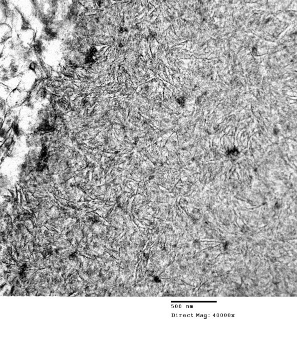 1D2 AD (Case 1) Polyglucosan body EM 129 - Copy - Copy