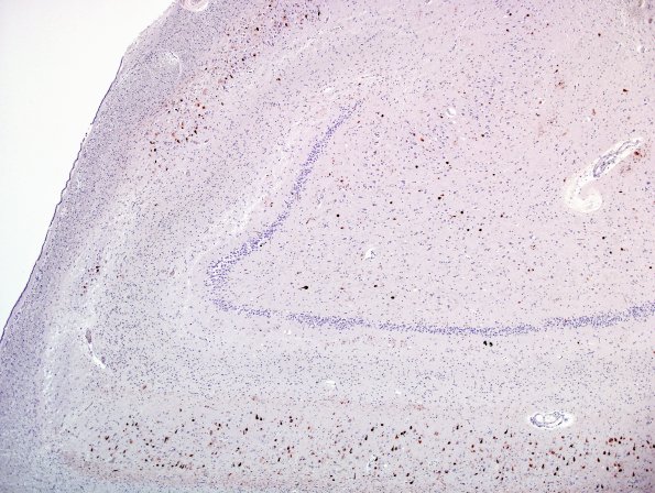 2B Hippocampal Neuron Loss (Case 2) PHF 4X.jpg