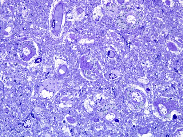 2C3 AD (Case 2) Histologic elements 100X 14 - Copy.jpg