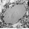 2D1 AD (Case 2) Ultrastructure EM 029 - Copy