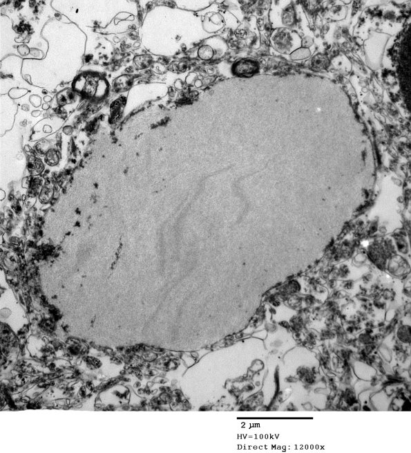 2D1 AD (Case 2) Ultrastructure EM 029 - Copy