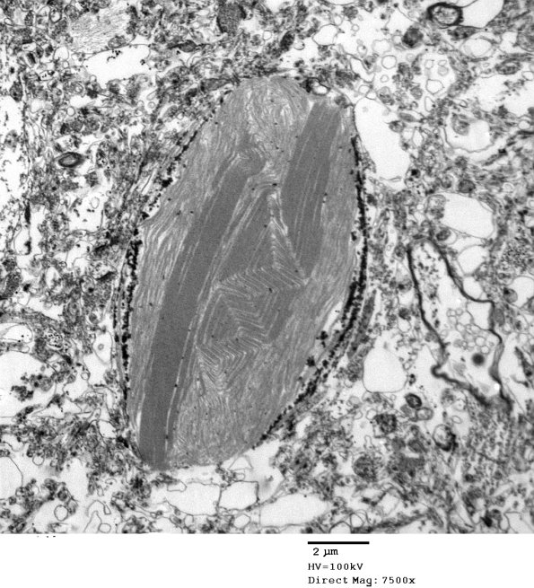 2D3 AD (Case 2) Ultrastructure EM 031 - Copy