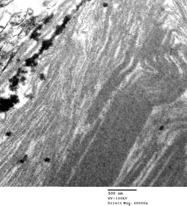 2D4 AD (Case 2) Ultrastructure EM 034 - Copy