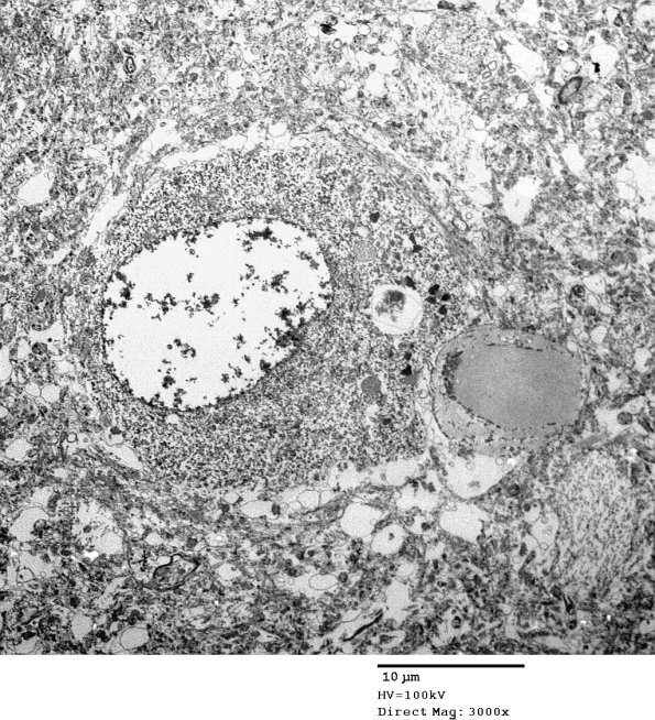 2D6 AD (Case 2) Ultrastructure EM 043 - Copy