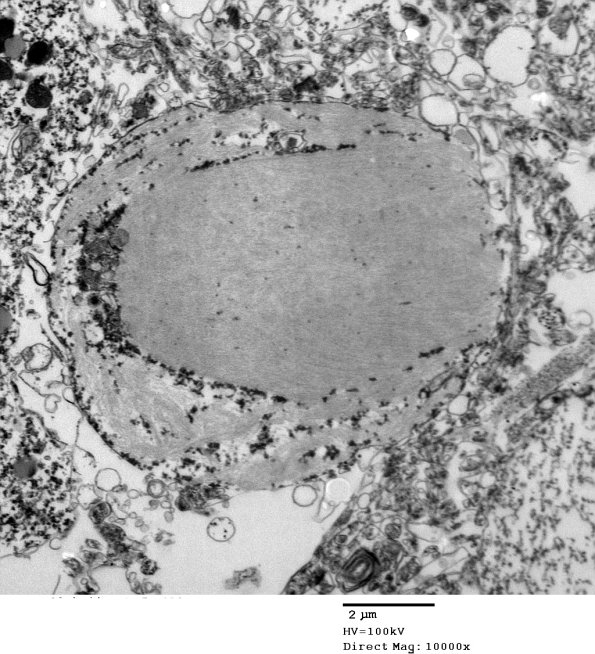 2D7 AD (Case 2) Ultrastructure EM 038 - Copy