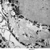 2D8 AD (Case 2) Ultrastructure EM 039 - Copy