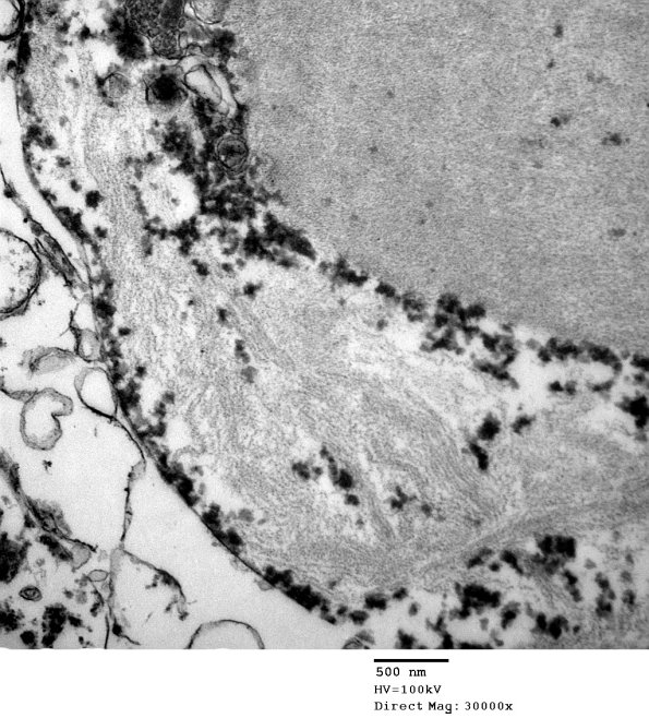 2D8 AD (Case 2) Ultrastructure EM 039 - Copy