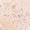 1C3 AD (Case 1) Synaptic pathology UB 20X 3