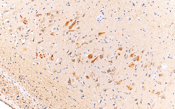 1C3 AD (Case 1) Synaptic pathology UB 20X 3