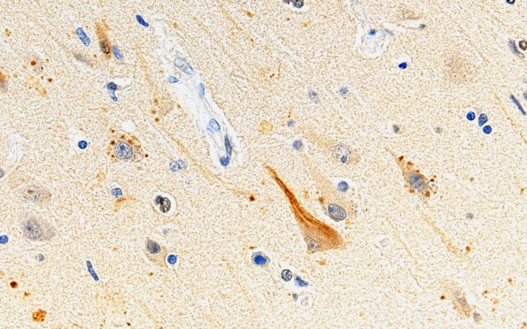 1C4 AD (Case 1) Synaptic pathology UB 60X 1