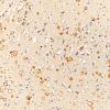 1C6 AD (Case 1) Synaptic pathology UB 20X 4