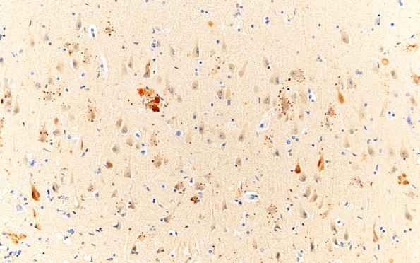 1C7 AD (Case 1) Synaptic pathology UB 20X 2