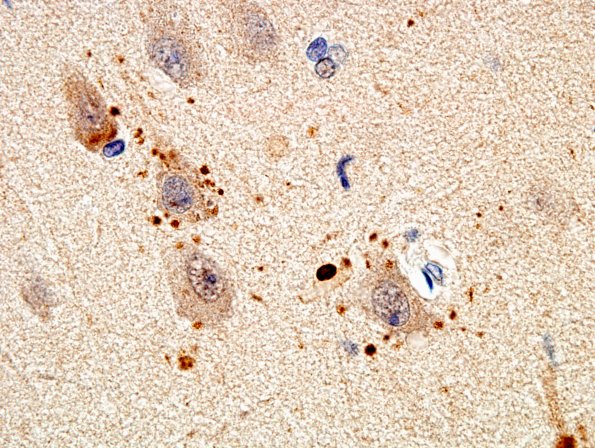 1C8 AD (Case 1) Synaptic pathology UB 1